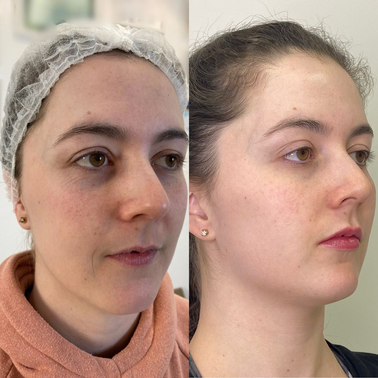 Antes e depois