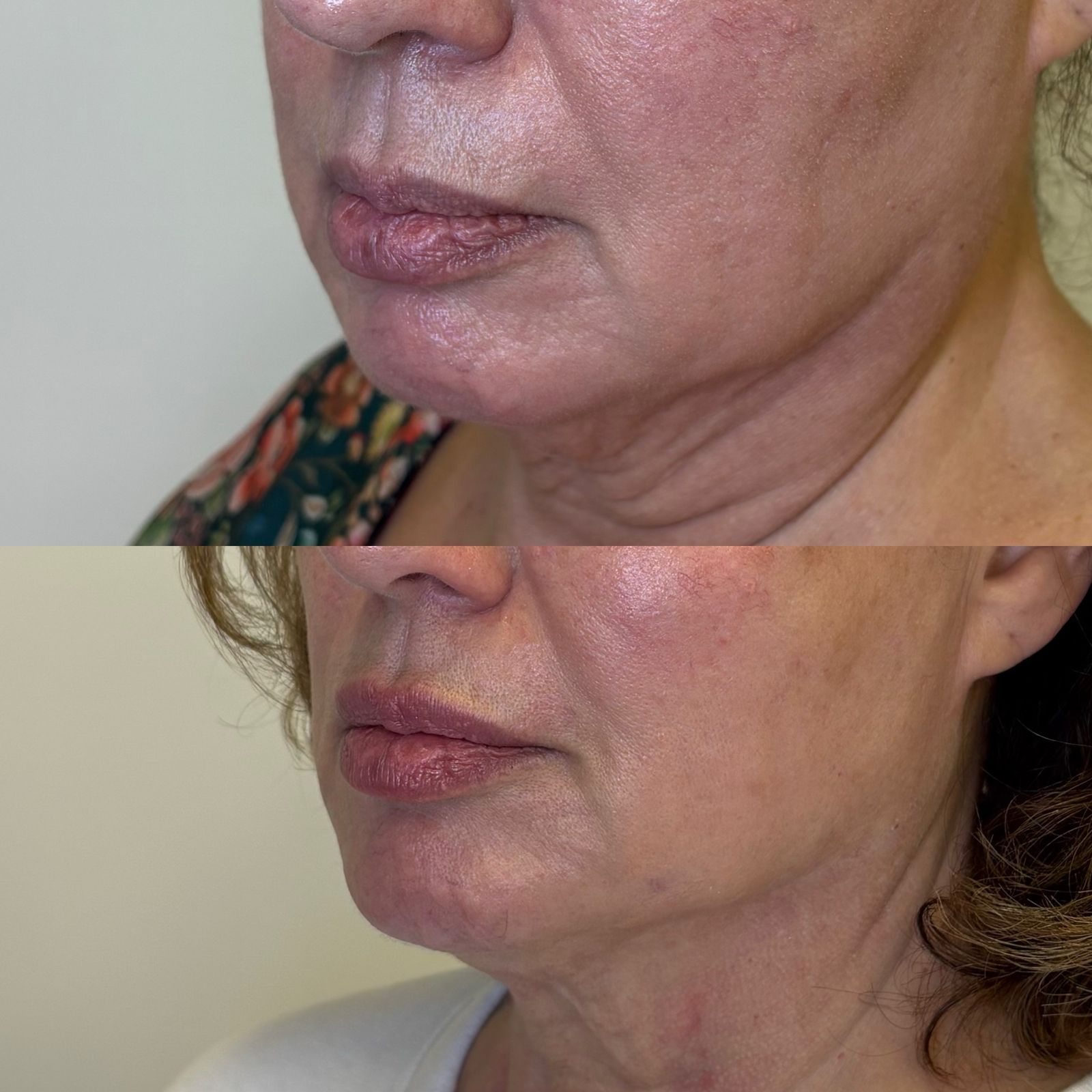 Antes e depois