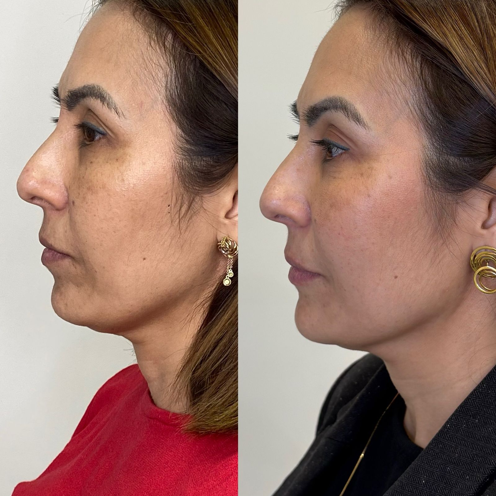 Antes e depois