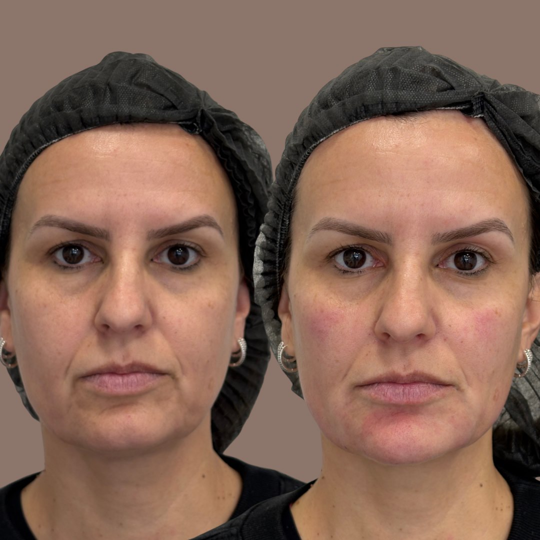 Antes e depois