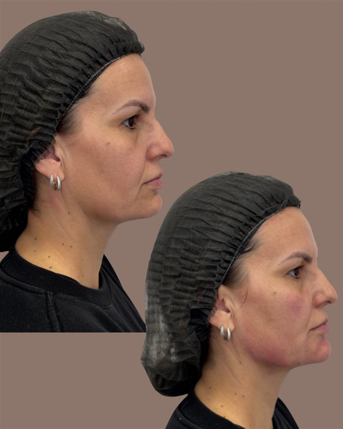 Antes e depois